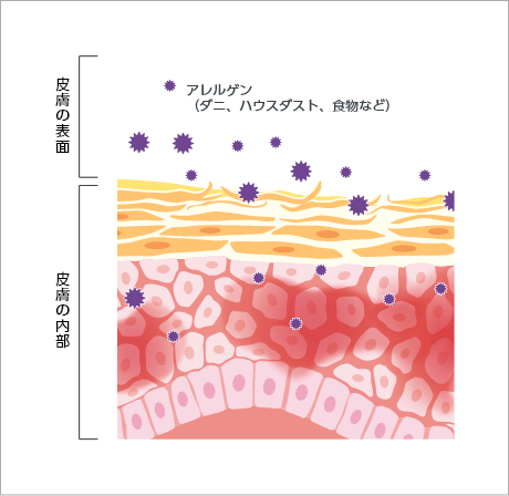 アトピー性皮膚炎の皮膚の表面と内部の断面図
                                                        