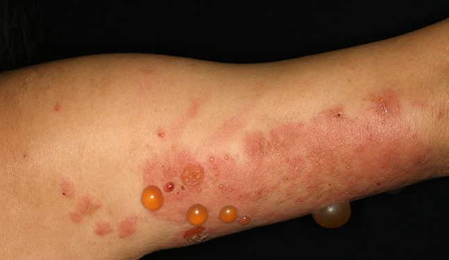 水疱/皮疹（紅斑）