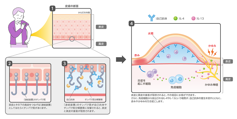 水疱性類天疱瘡の原因