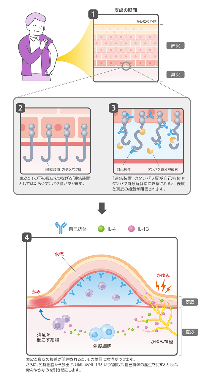 水疱性類天疱瘡の原因
