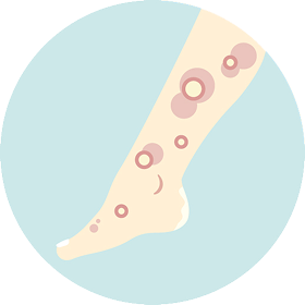 水疱性類天疱瘡とは