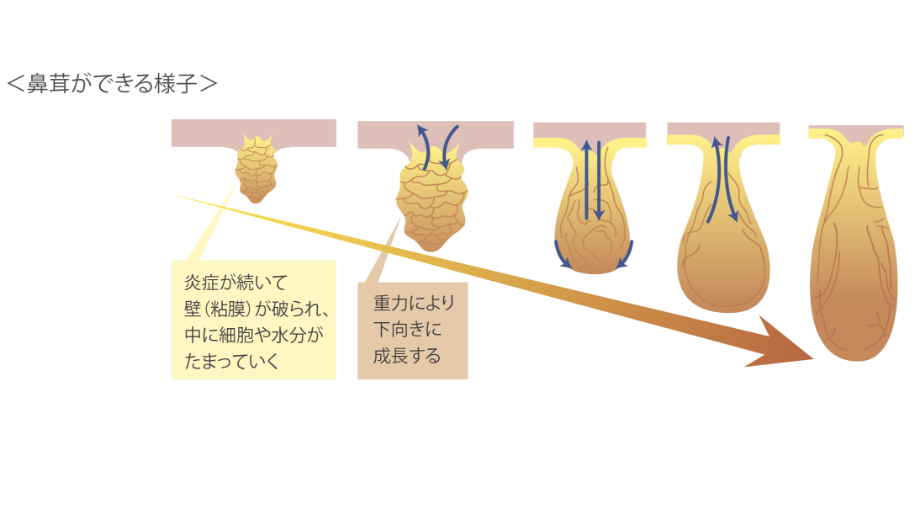 ポリープを伴う慢性副鼻腔炎とは何ですか?