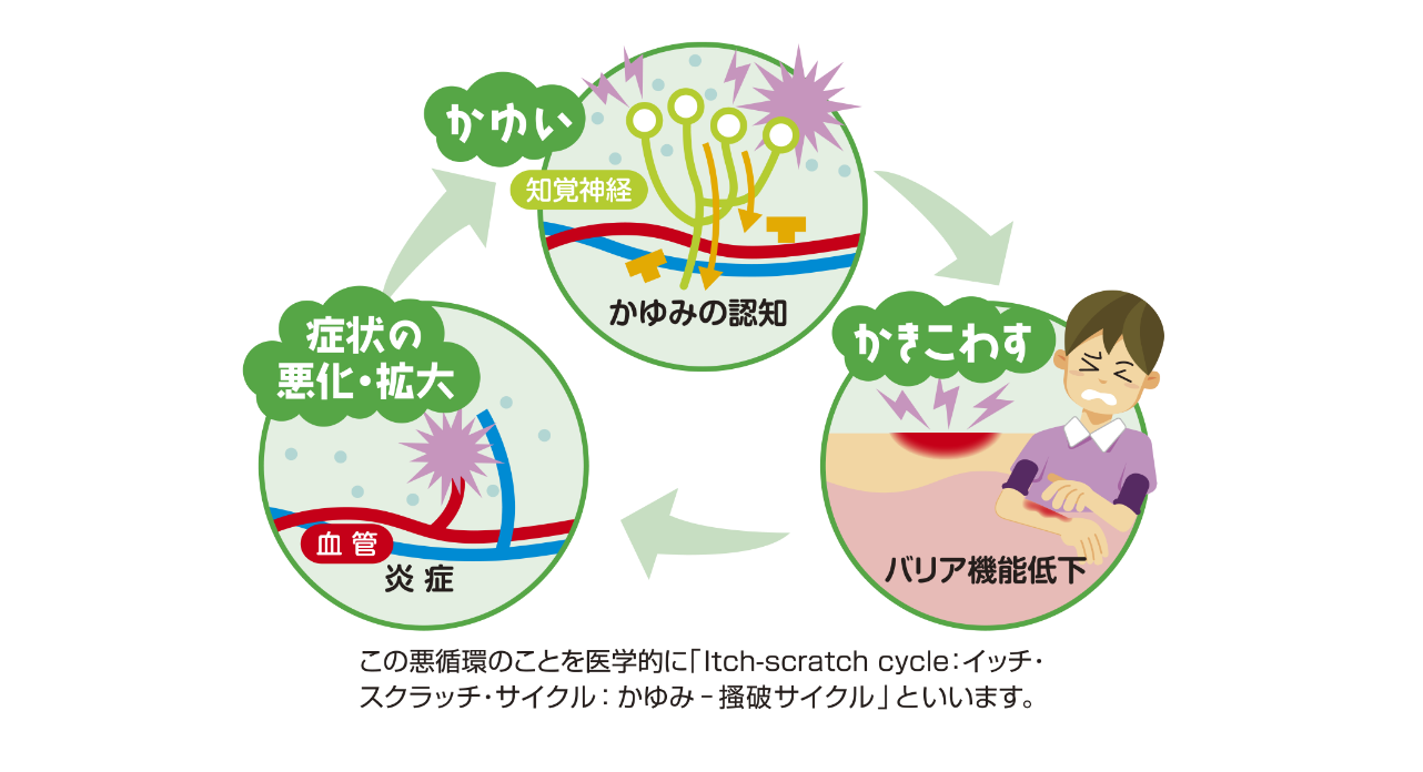 itch-scratch cycle（イッチ・スクラッチサイクル）