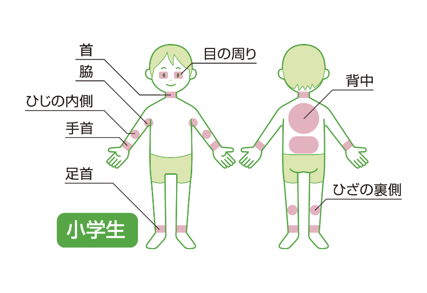 アトピー性皮ふ炎　小学生