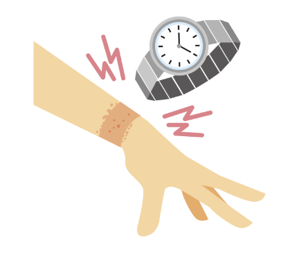 かぶれ（接触性皮ふ炎）